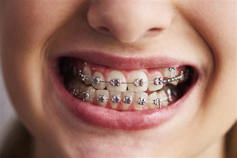 The Magic of Braces: How Teeth Move 